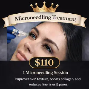 1- Microneedling treatment promotional offer